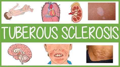 Tuberous Sclerosis Complex In Minutes Youtube