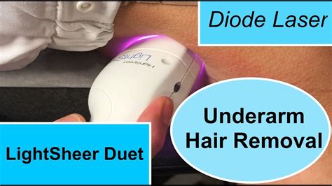 The Lightsheer Duet Diode Laser For Underarm Hair Removal Youtube