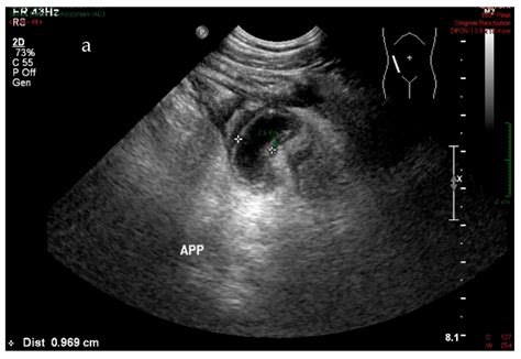 A Year Old Female Suspected Of Acute Appendicitis Ultrasonography