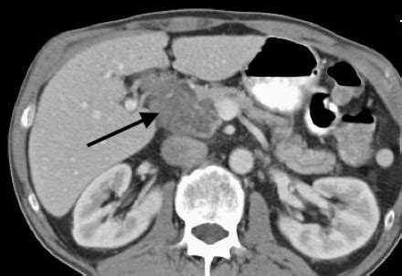 Figure Serous Cystadenoma As Seen By CT Contributed By Christopher