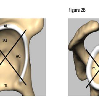 In anatomy and physiology, the term 'labrum' is used to refer to an edge or a brim. Labral quadrants of (A) the hip and (B) shoulder. A. AL: Acetabular... | Download Scientific Diagram