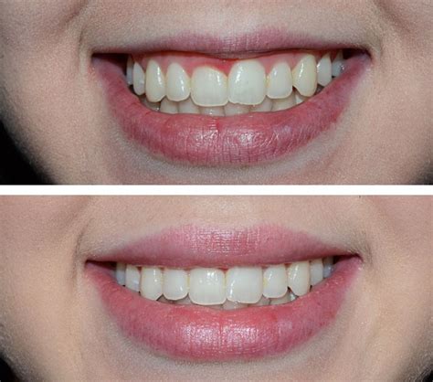 Botoks Gummy Smile İçin Diş Eti Gülüşü En Etkin Çözüm