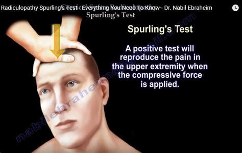 Cervical Spine Radiculopathy And Spurling Test —