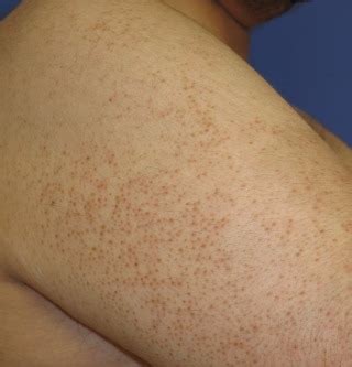 Acne will turn red eventually. What Causes Dry and Bumpy Skin on Your Arms? What to Do ...