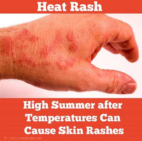 Heat Rash On Adults