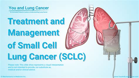 Slide Show Treatment And Management Of Small Cell Lung Cancer SCLC