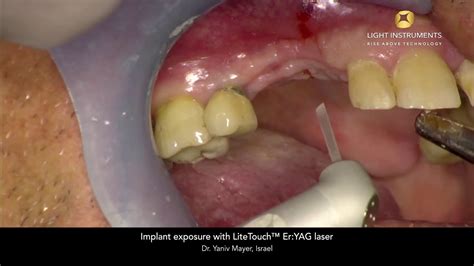 Implant Exposure With Litetouch™ Eryag Laser Youtube