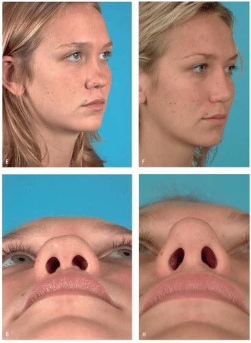 Rhinoplasty Reconstruction Of The Saddle Nose Deformity Using Costal