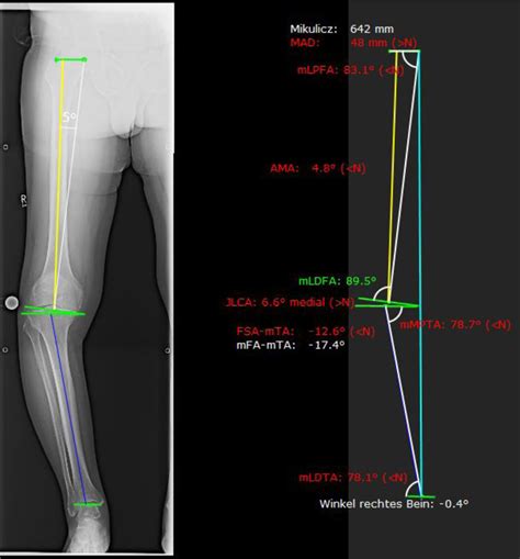 This Figure Illustrates Measurements Of The Hip Knee Ankle Hka The