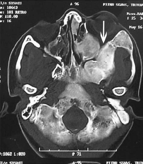 Axial Ct Scan Of The Skull In A Case Of Craniofacial Fibrous Dysplasia