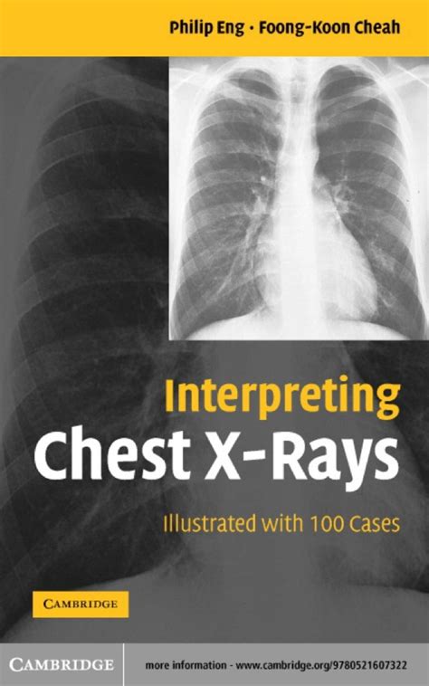 Interpreting Chest X Rays 1st Edition Ebook In 2021 Medical