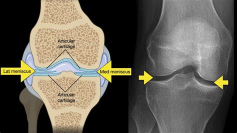 Anatomy Of Knee X Rays Youtube