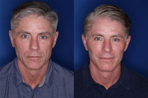 Plastic Surgery Before And After Men Face