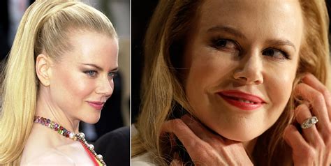 Nicole Kidmans Face Sparks Conversation About Botox Wtop