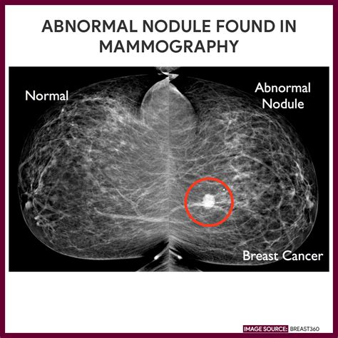 Mammography Mammogram Nursing Responsibilities Nurseslabs