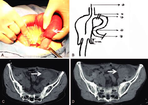 A Intraoperative Findings Revealed That The Retrograde Jejunojejunal Download Scientific