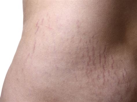 Stretch Mark 67 Degrees Cosmetic Clinic