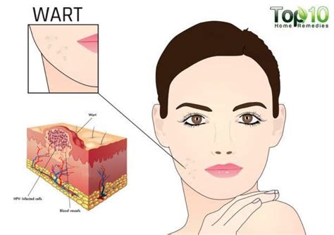 How To Get Rid Of Flat Warts Top 10 Home Remedies Flat Warts Skin
