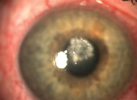 Evaluation And Management Of Corneal Abrasions