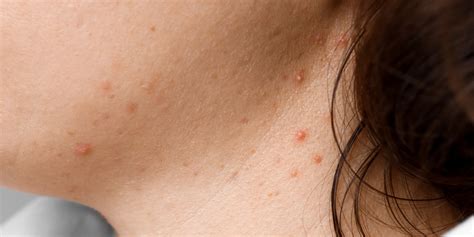 Causes Of Pimples And How To Cure Them Naturally Home Health Care