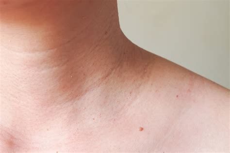 Warts Skin Tags Removal Pure Derma Clinic