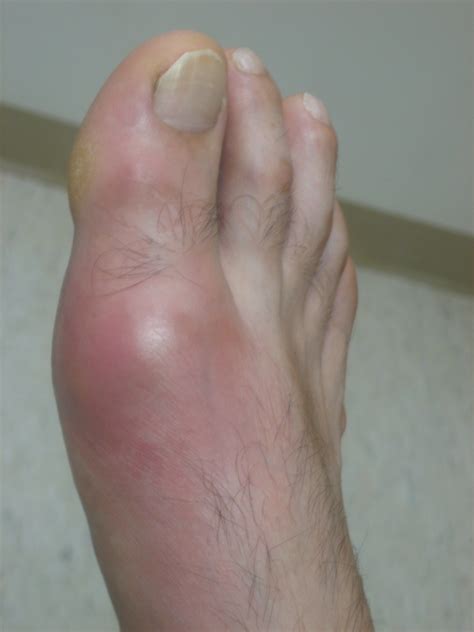 Warm Red Swollen Joint In A Middle Age Mangout Until Proven