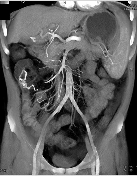 Cirrhosis With Clot In The Portal Vein And Superior Mesenteric Vein