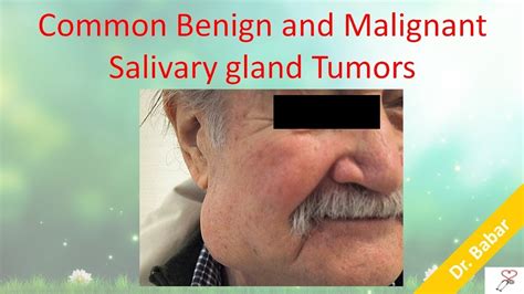 Common Benign And Malignant Salivary Gland Tumors Youtube