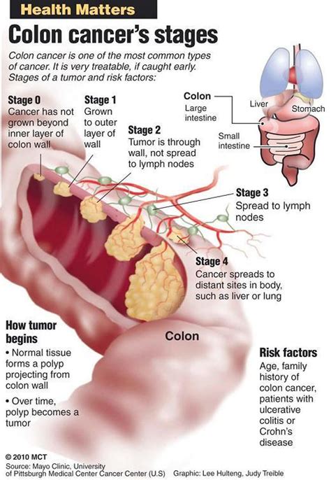 Signs & symptoms of colon cancer. Guard against colon cancer