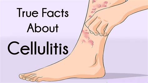 cellulitis rash stages
