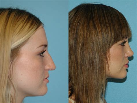 nose surgery before and after photos patient 75 san francisco ca kaiser permanente cosmetic