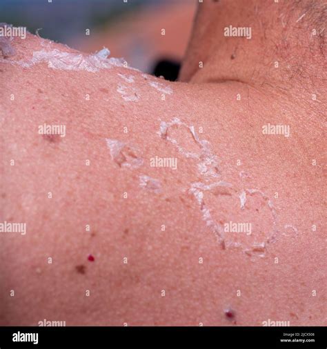 Sunburn Closeup Of Peeling Sunburned Skin On Back And Shoulder Stock