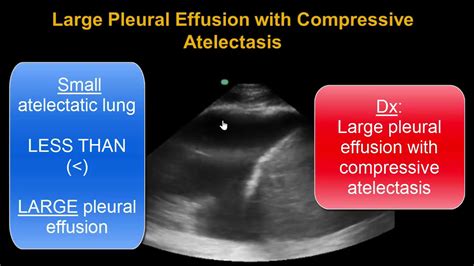Lung Ultrasound Consolidation Atelectasis Or Pneumonia Youtube