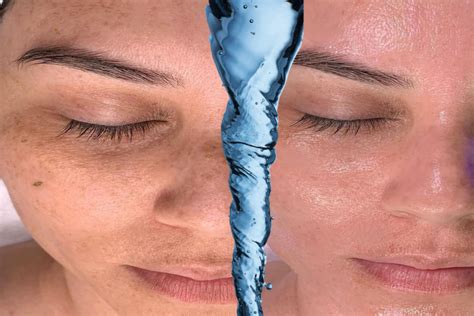 Hydrafacial Before And After Photos Results