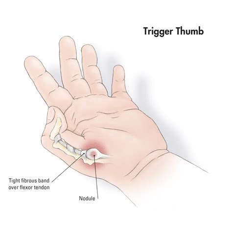 Best Trigger Finger Treatment In Gurgaon Pal Physiotherapy