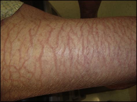 Beware Of Underlying Malignancy Acquired Ichthyosis The American