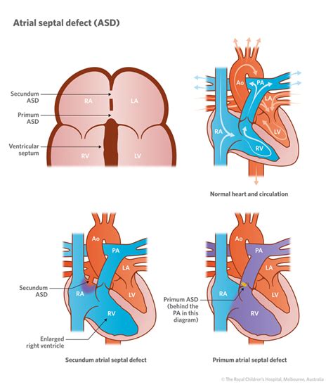 Cardiology Atrial Septal Defect