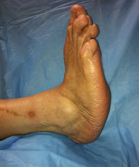 Diabetic Foot Problems Pain Ulcer Infection And Diabetic Foot Treatment