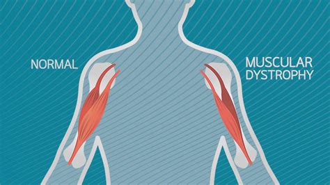 Muscular Dystrophy Anatomy