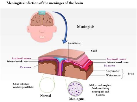0814 Meningitis Infection Of The Meninges Of The Brain