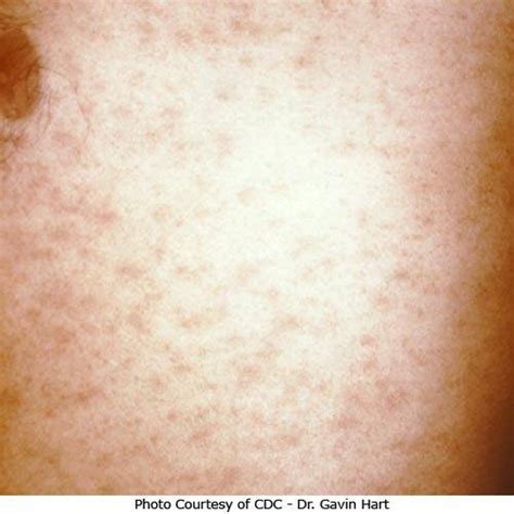 Pityriasis Rosea Pictures Causes Symptoms And Treatment