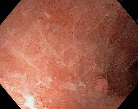 Ulcerative Colitis Endoscope Image Stock Image C0166676 Science