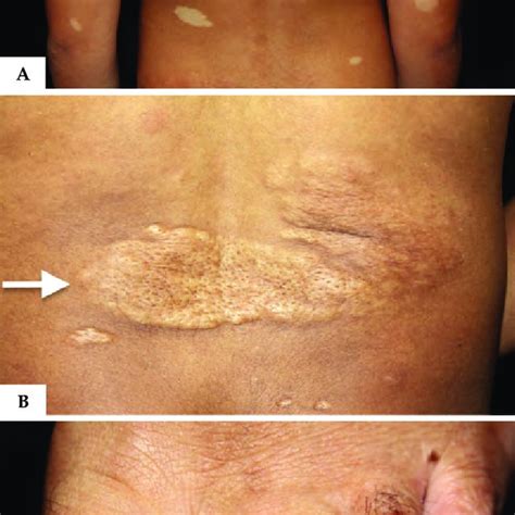 Reyhan Blog Ash Leaf Shagreen Patch Skin Tuberous Sclerosis
