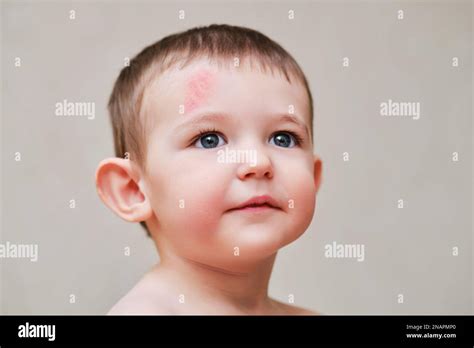 Bruise On Wound Child Forehead Hi Res Stock Photography And Images Alamy