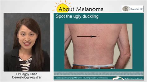 Melanoma The Ugly Duckling Youtube
