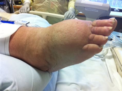 Lymphedema Angiologist