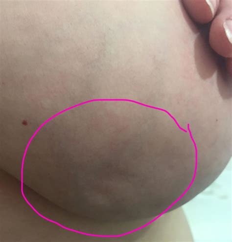 What do breast lumps feel like? Woman's Facebook Photo On Lesser-Known Breast Cancer ...