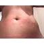 Continuos Skin Rash Which Has Trigger But Not Known  Microbiology And