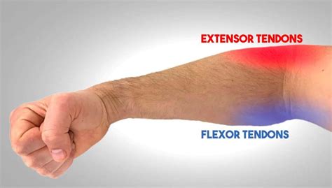 How Elbow Sleeves Can Help Your Tendonitis And Which Ones To Wear