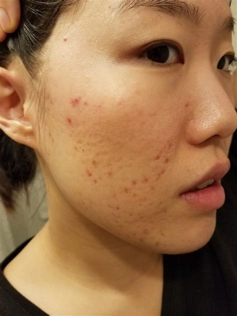 Sunday Riley “good Genes” On Acne Scars And Fine Lines Before And Afters